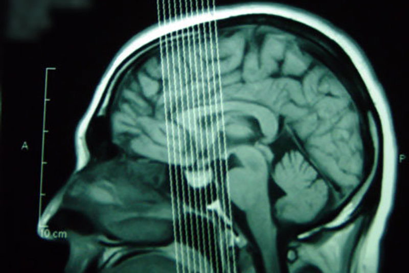 MRI scan of Christopher Gronlund's brain