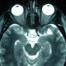 An MRI scan of a brain.